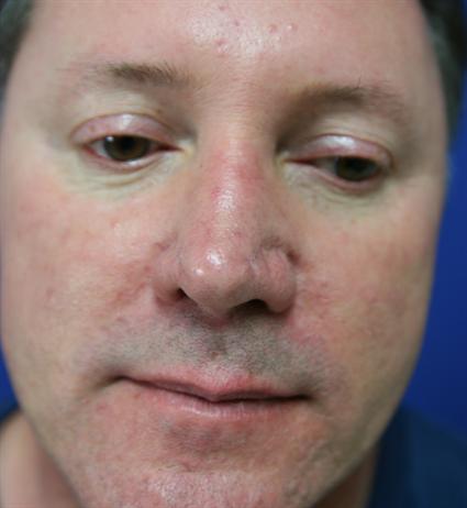 male corrective nose surgery-before