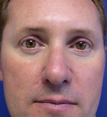 CORRECTIVE NOSE SURGERY 242