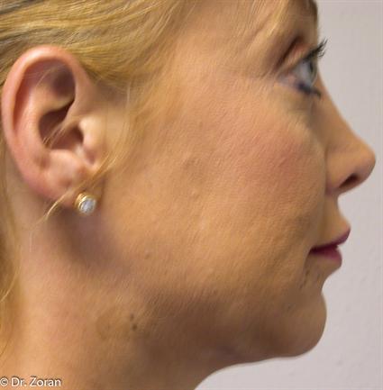 facial-jaw-implant-before