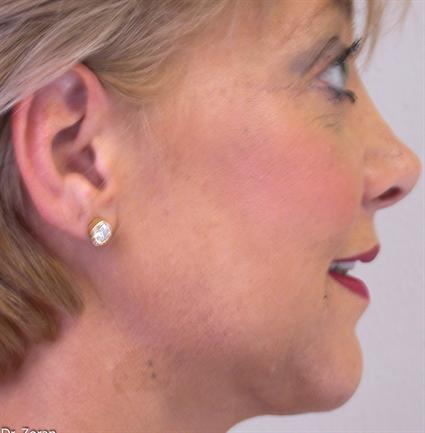 FACIAL, JAW IMPLANTS 243