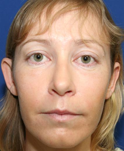 before-facial-cheek-implants