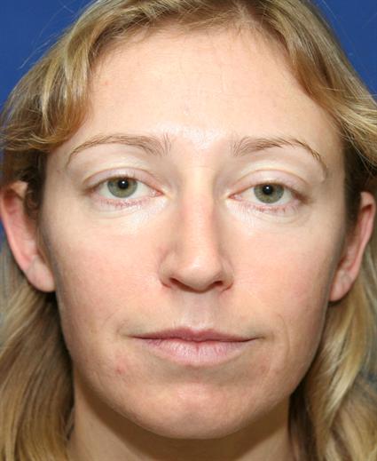 FACIAL, CHEEK IMPLANTS - FACIAL FAT GRAFTS - RHINOPLASTY - NOSE SURGERY REVISION 244