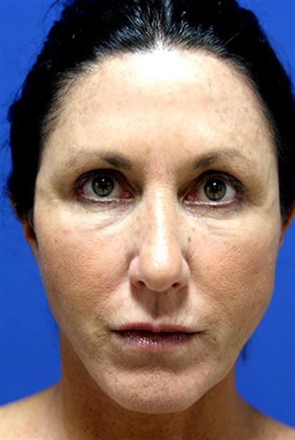 FACE LIFT AND BLEPHAROPLASTY 262