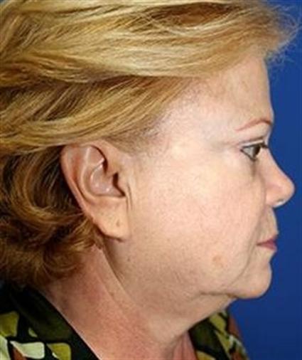 before-face-lift-and-neck-lift