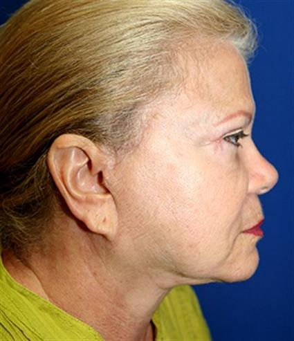 FACE LIFT 263