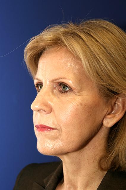 before-face-lift-and-neck-lift