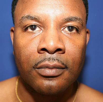 facial-fat-graft-before