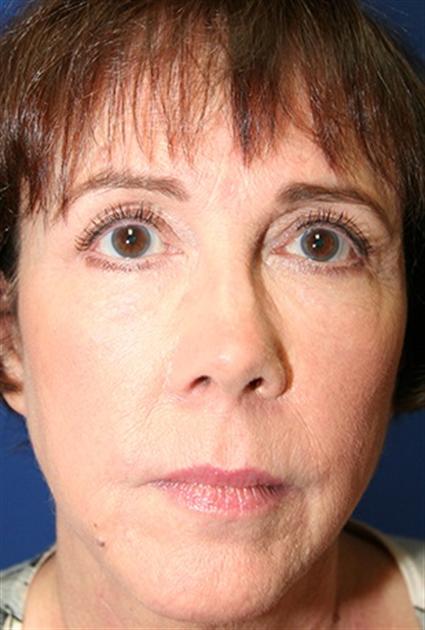 FACIAL FAT GRAFTS 268