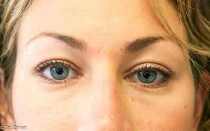 before- eyelid-surgery-blepharoplasty