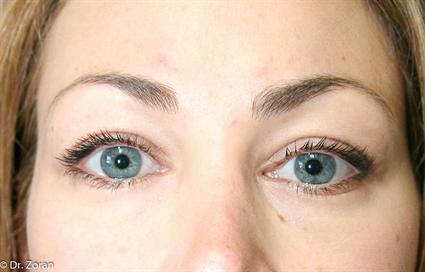 BLEPHAROPLASTY - EYELID SURGERY 27