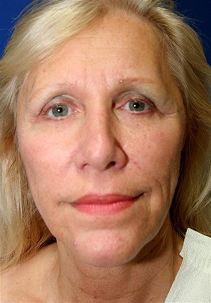 FACIAL FAT GRAFTS 270