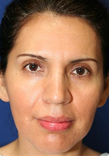 facial-fat-graft
