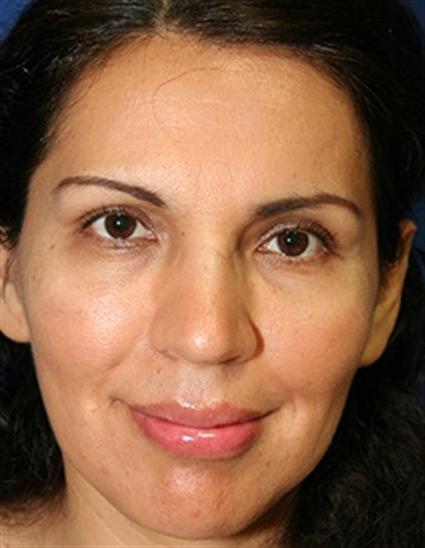 FACIAL FAT GRAFTS 271