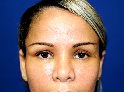 BROW LIFT 273