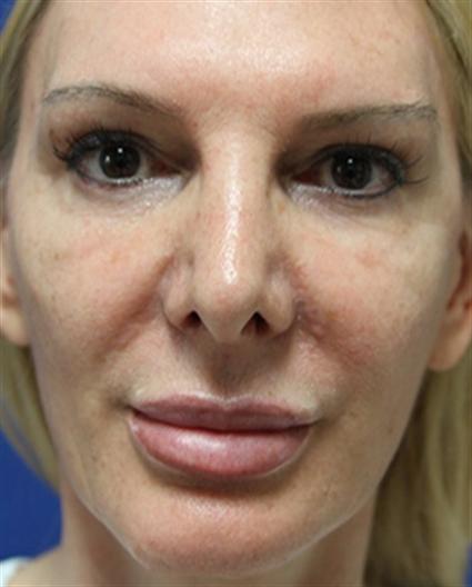 forehead-contouring-before