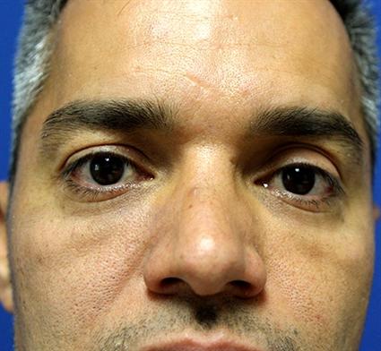 before-facial-cheek-implants