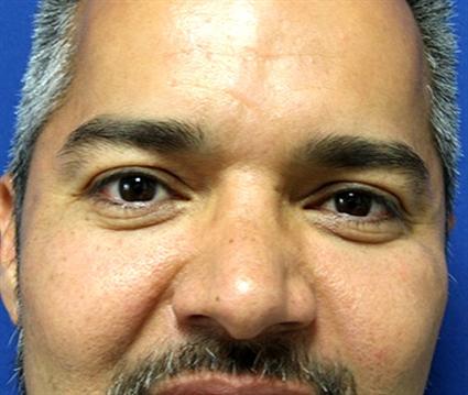 FACIAL, CHEEK IMPLANTS 275