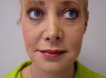 FACIAL, CHEEK IMPLANTS 276