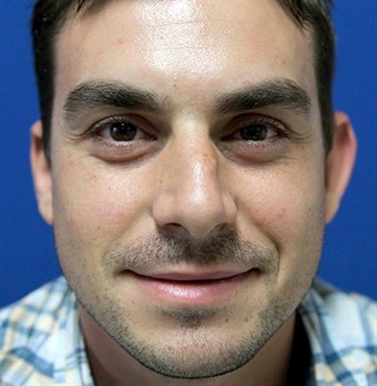male-before-otoplasty-ear-shaping