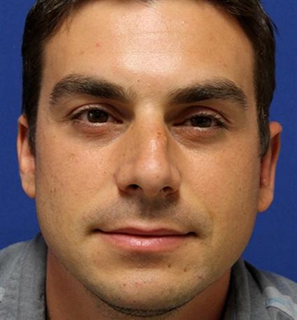 OTOPLASTY - EAR SHAPING 277