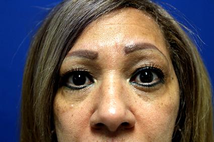 eyelid-surgery-blepharoplasty-before