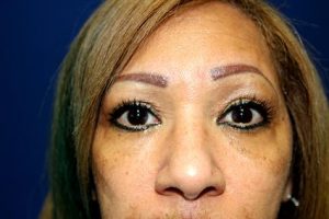 eyelid-surgery-blepharoplasty-after
