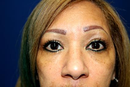 BLEPHAROPLASTY - EYELID SURGERY & CHEEK IMPLANTS 278