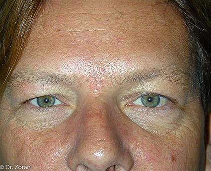 lower eyelid surgery-before