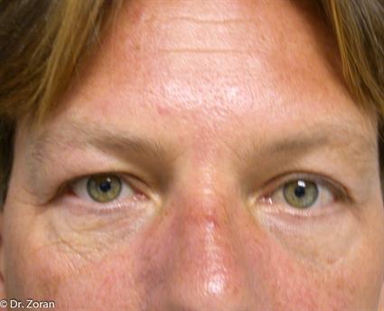LOWER EYELID SURGERY 28