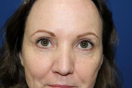 BLEPHAROPLASTY - EYELID SURGERY 281