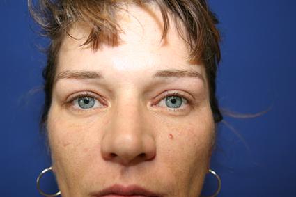 BLEPHAROPLASTY - EYELID SURGERY 283