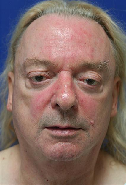 face-lift-and-neck-lift
