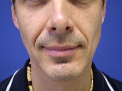 facial-jaw-implant-before