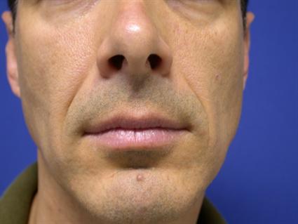 FACIAL FAT GRAFTS 286