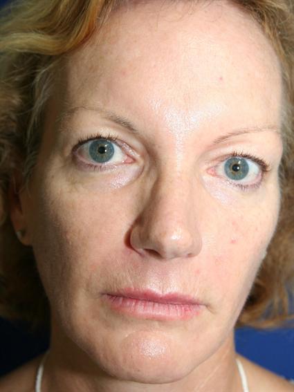 facial-fat-graft-before