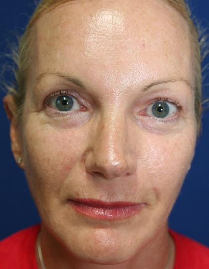 FACIAL FAT GRAFTS 287