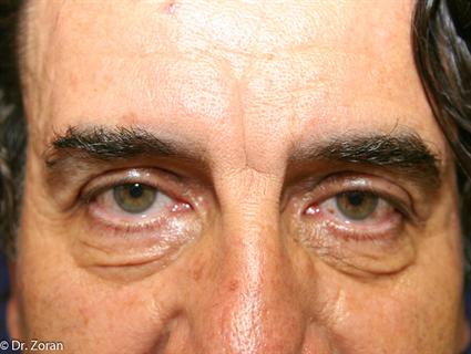 male-before-brow-lift