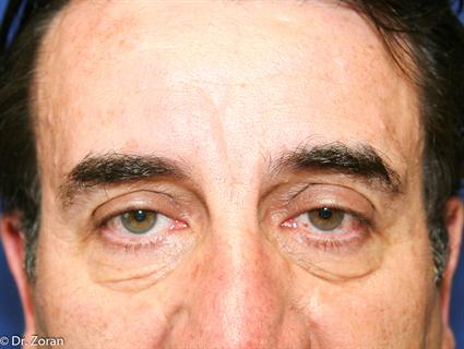 BROW LIFT CASE 29