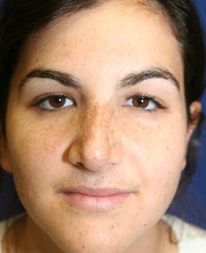 RHINOPLASTY - NOSE SURGERY 291
