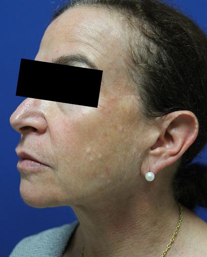 NECK LIFT 292