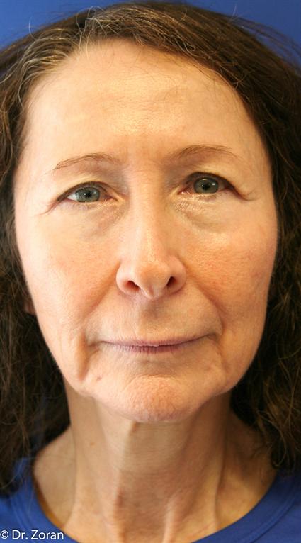 face-lift-and-neck-lift
