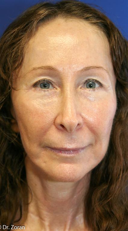 FACE LIFT AND NECK LIFT 30