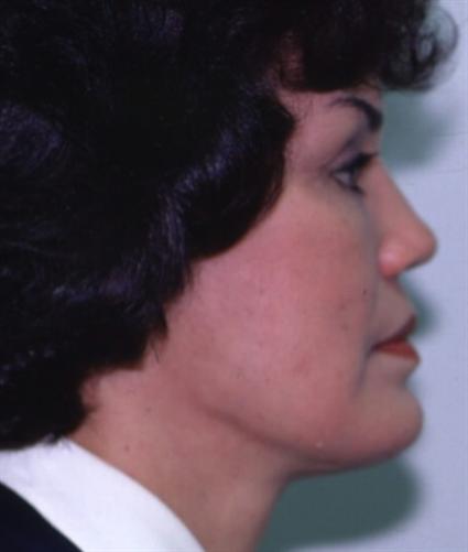 FACE LIFT AND NECK LIFT 305