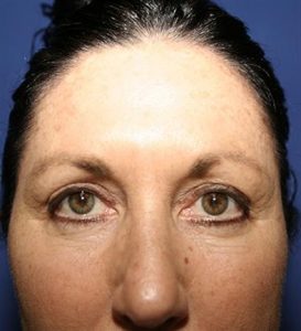eyelid-surgery-blepharoplasty-before