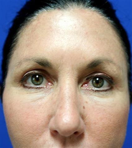 BLEPHAROPLASTY - EYELID SURGERY CASE 306