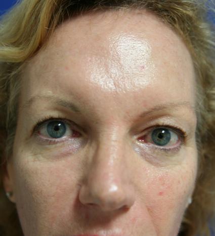 forehead contouring-before