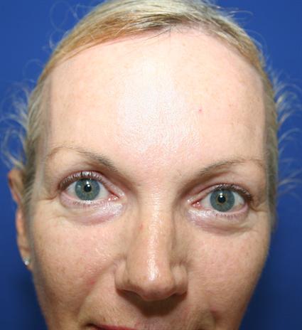 EYELID RECONSTRUCTION CASE 307