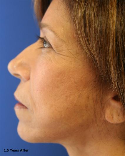 face-lift-and-neck-lift