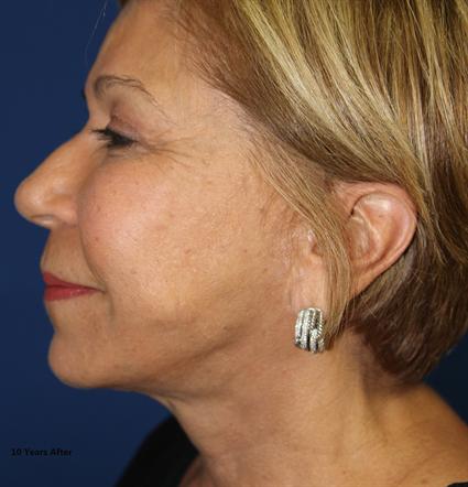 FACE LIFT 309