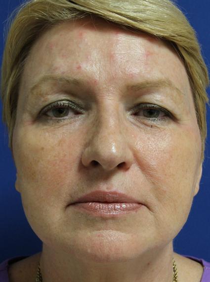 before rhinoplasty